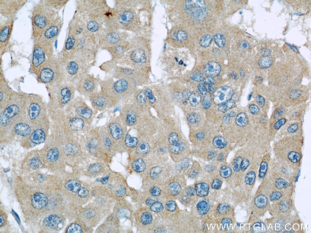 IHC staining of human liver cancer using 60075-1-Ig