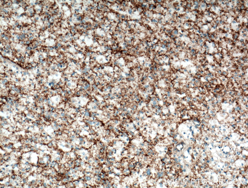 Immunohistochemistry (IHC) staining of human gliomas tissue using Septin 5 Polyclonal antibody (11631-1-AP)