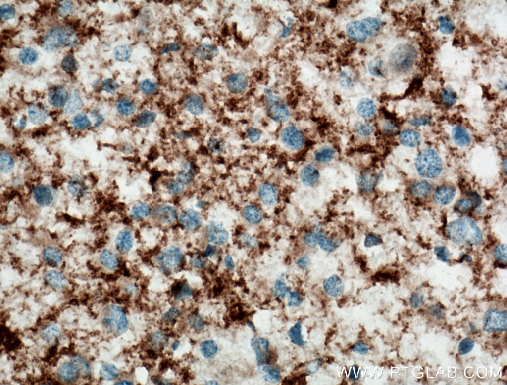Immunohistochemistry (IHC) staining of human gliomas tissue using Septin 5 Polyclonal antibody (11631-1-AP)