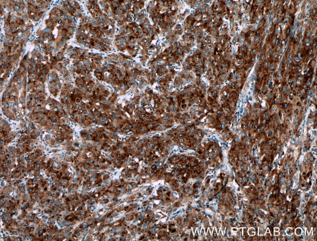 Immunohistochemistry (IHC) staining of human cervical cancer tissue using Septin 6 Polyclonal antibody (12805-1-AP)