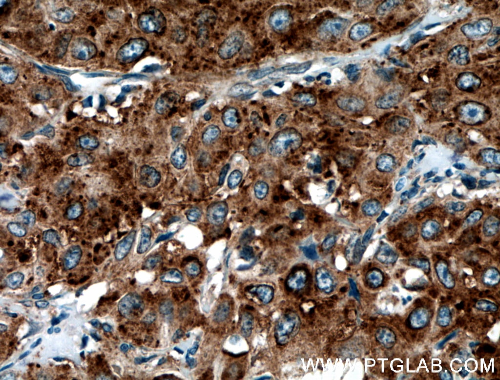 Immunohistochemistry (IHC) staining of human cervical cancer tissue using Septin 6 Polyclonal antibody (12805-1-AP)