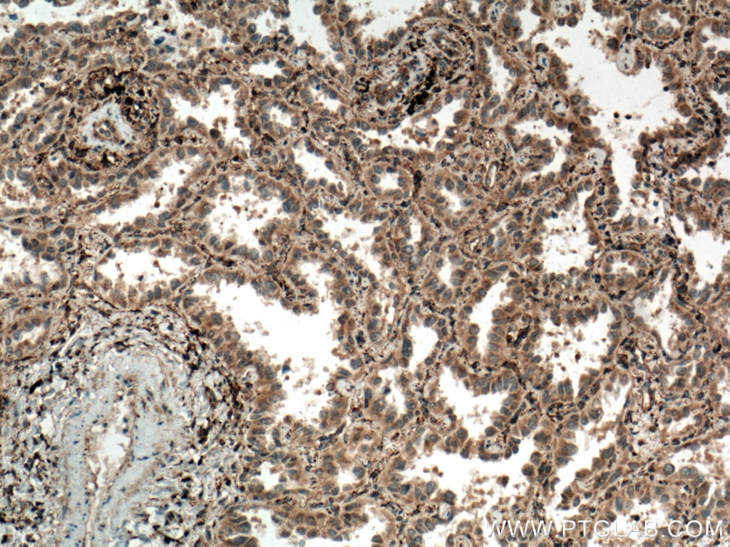 Immunohistochemistry (IHC) staining of human lung cancer tissue using Septin 7 Polyclonal antibody (13818-1-AP)