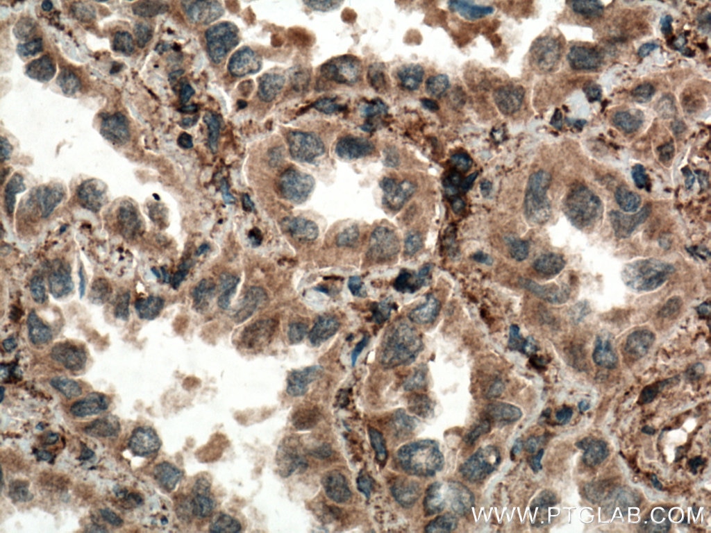 Immunohistochemistry (IHC) staining of human lung cancer tissue using Septin 7 Polyclonal antibody (13818-1-AP)