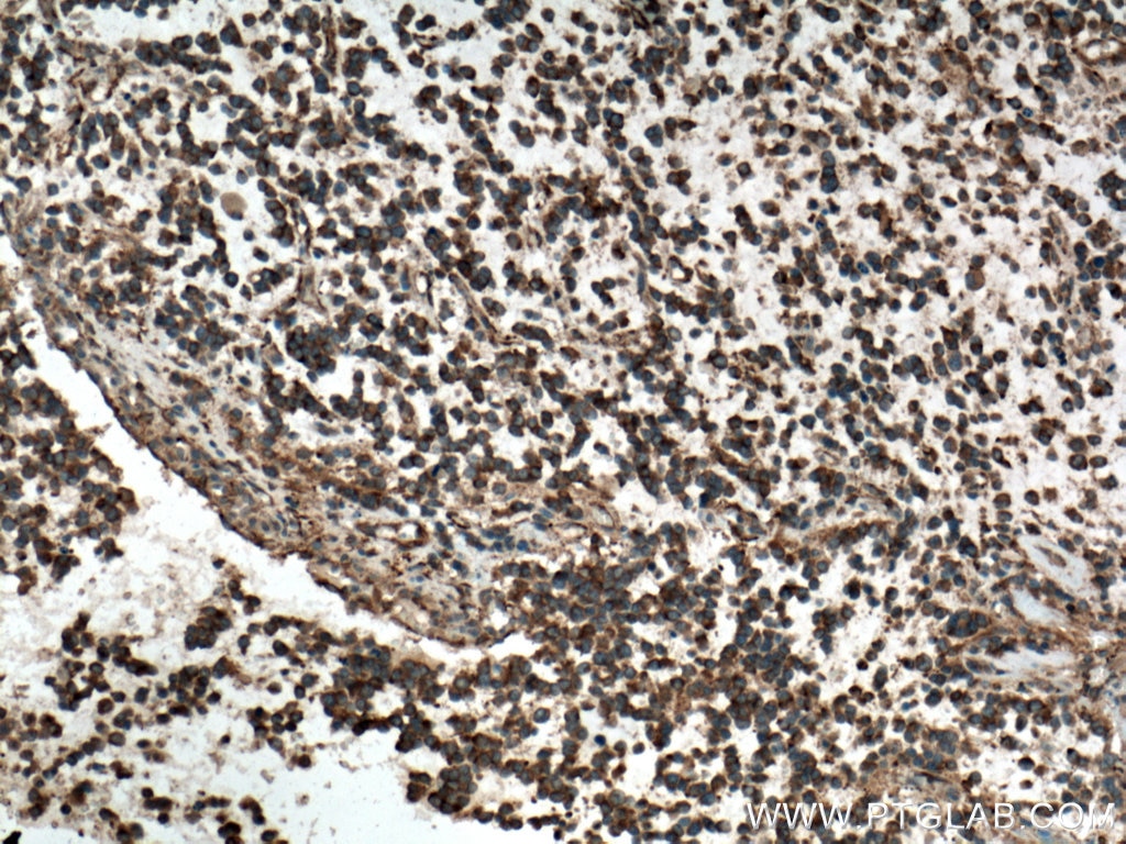 Immunohistochemistry (IHC) staining of human gliomas tissue using Septin 7 Polyclonal antibody (13818-1-AP)