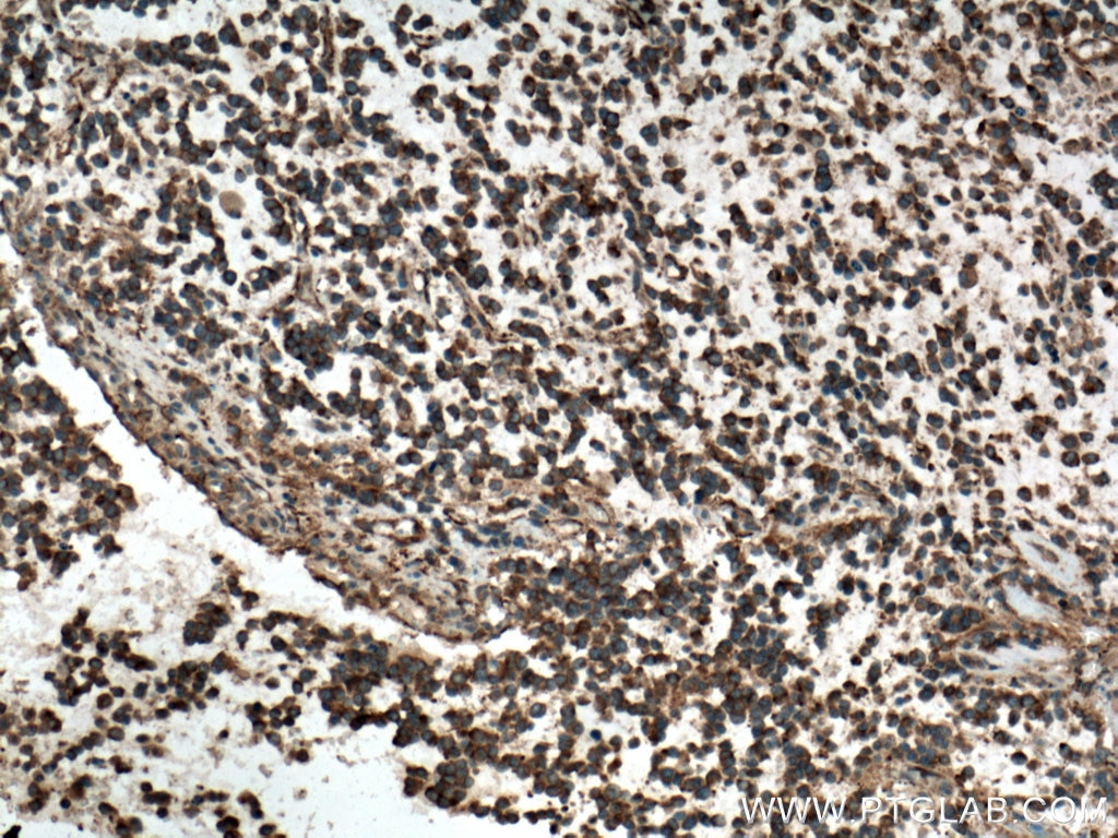 IHC staining of human gliomas using 13818-1-AP