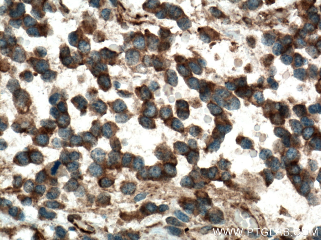 IHC staining of human gliomas using 13818-1-AP