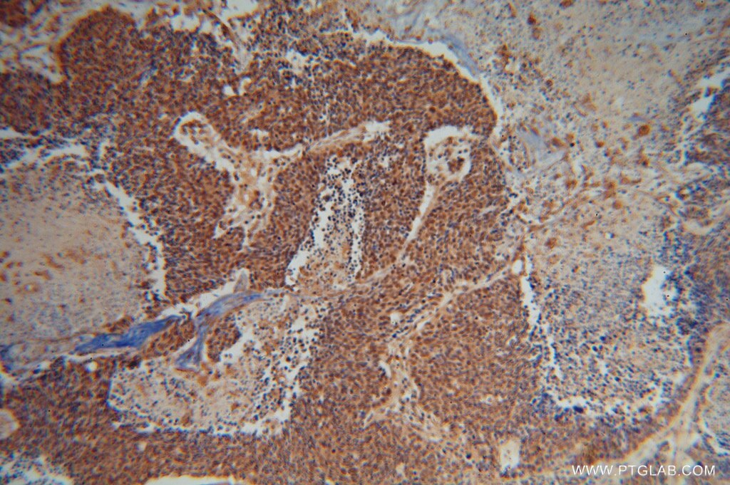 IHC staining of human lung cancer using 13818-1-AP