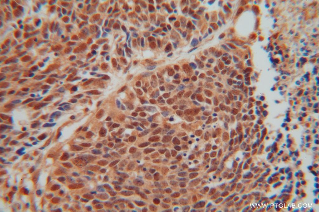 Immunohistochemistry (IHC) staining of human lung cancer tissue using Septin 7 Polyclonal antibody (13818-1-AP)