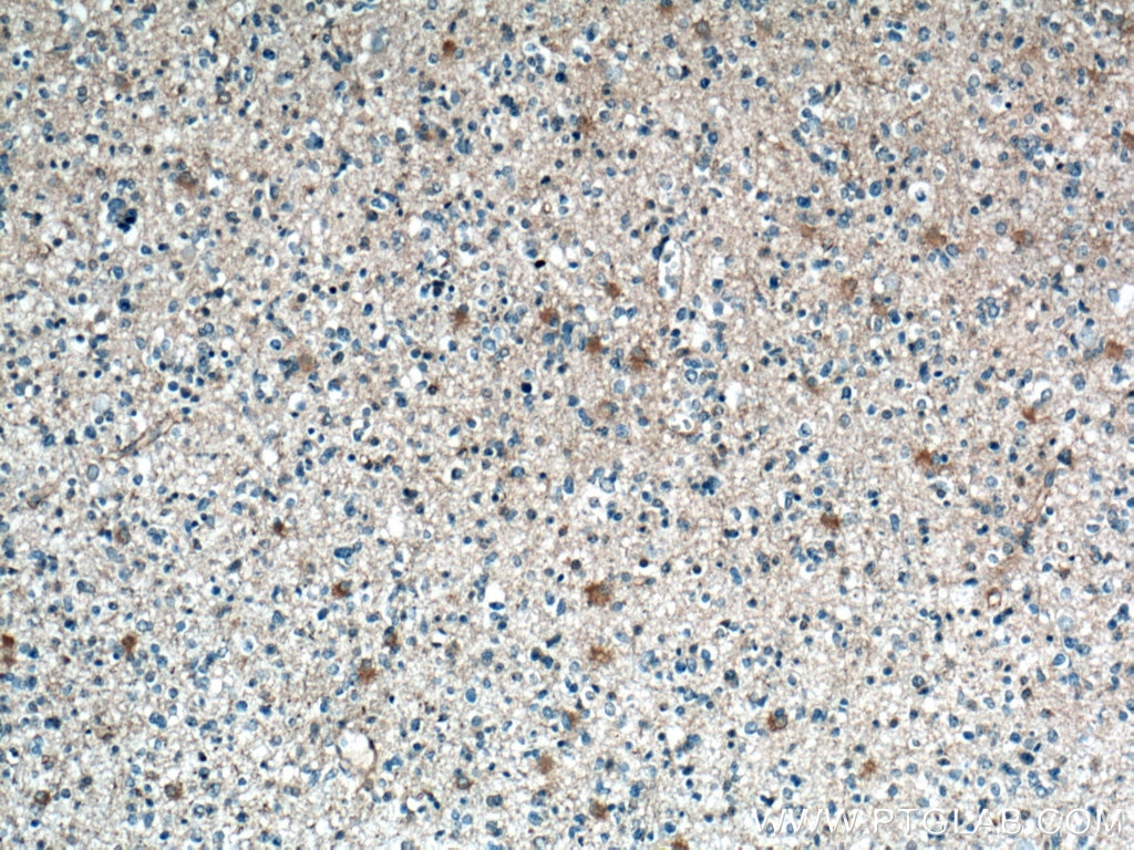 Immunohistochemistry (IHC) staining of human gliomas tissue using Septin 7 Monoclonal antibody (66542-1-Ig)