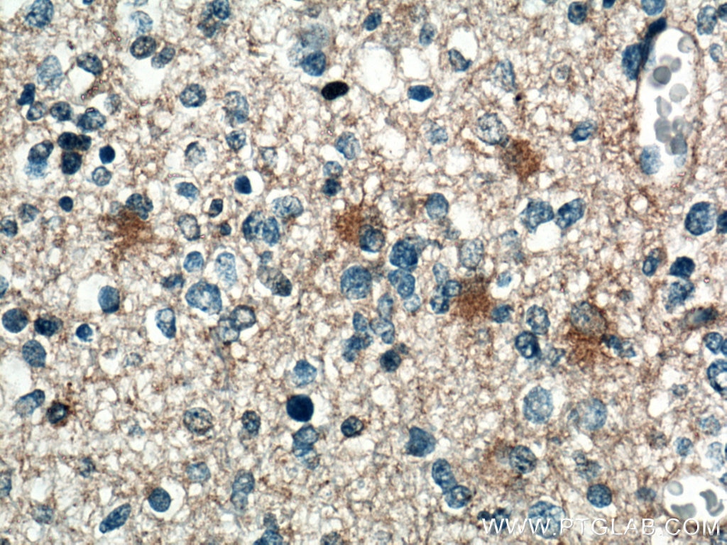 Immunohistochemistry (IHC) staining of human gliomas tissue using Septin 7 Monoclonal antibody (66542-1-Ig)