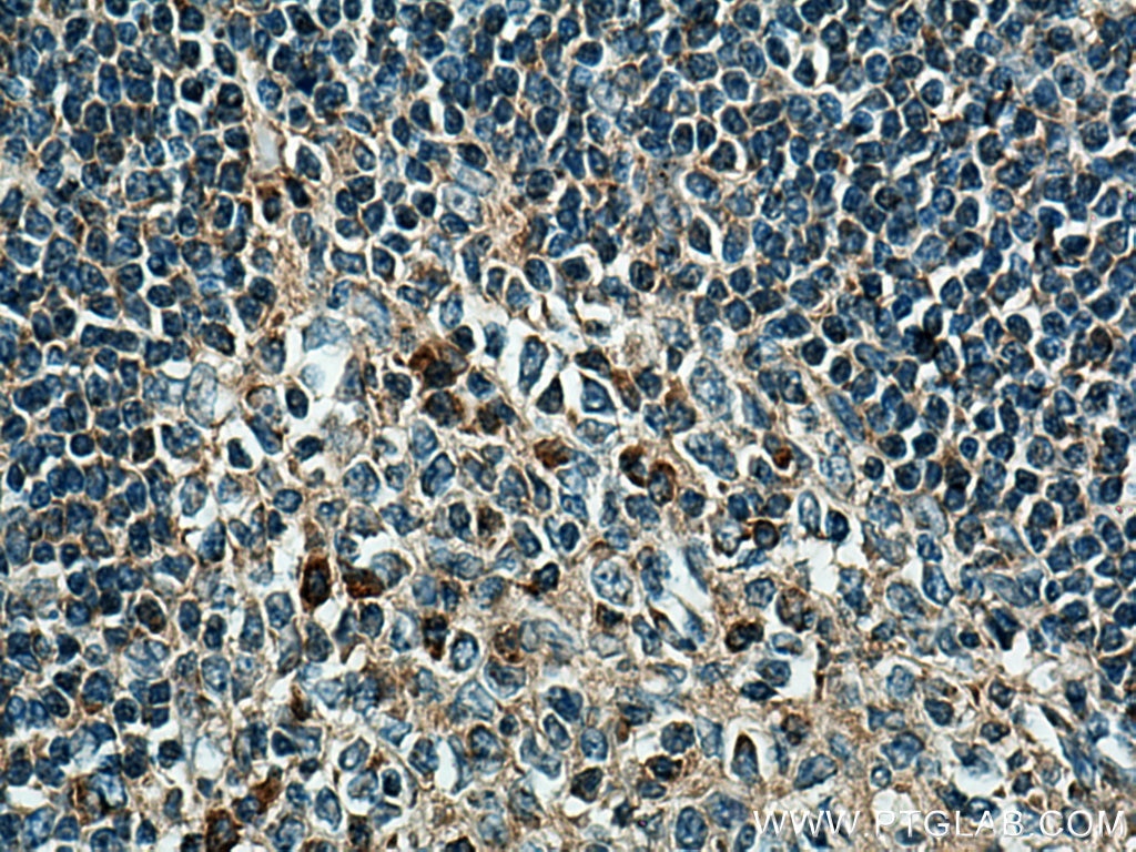 Immunohistochemistry (IHC) staining of human tonsillitis tissue using Septin 7 Monoclonal antibody (66542-1-Ig)