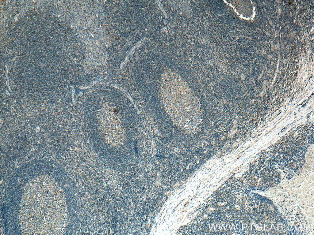 IHC staining of human tonsillitis using 66542-1-Ig