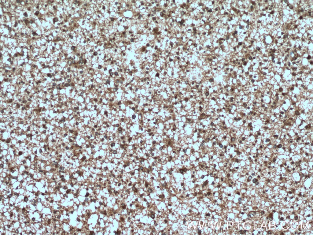 Immunohistochemistry (IHC) staining of human gliomas tissue using Septin 8 Polyclonal antibody (11769-1-AP)