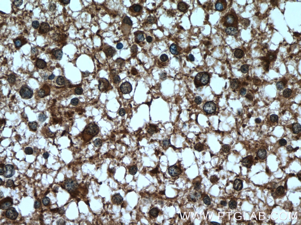 Immunohistochemistry (IHC) staining of human gliomas tissue using Septin 8 Polyclonal antibody (11769-1-AP)