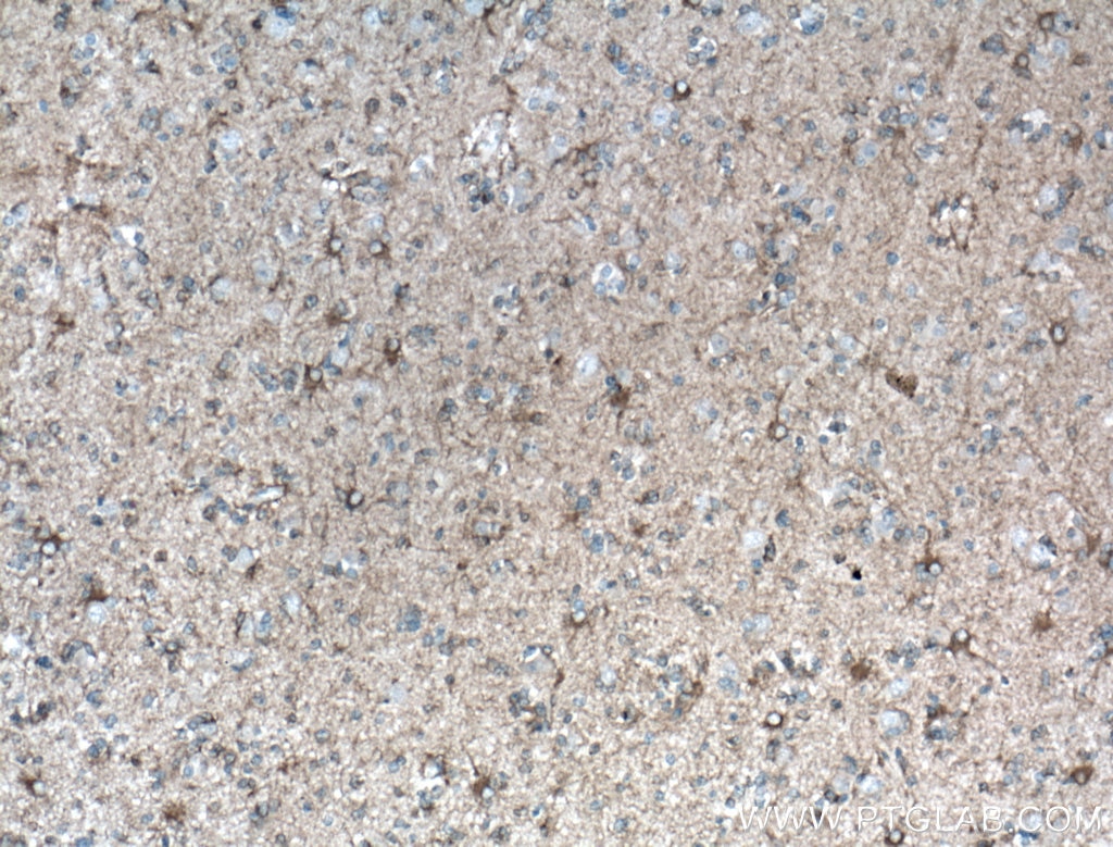 Immunohistochemistry (IHC) staining of human gliomas tissue using Septin 8 Polyclonal antibody (11769-1-AP)