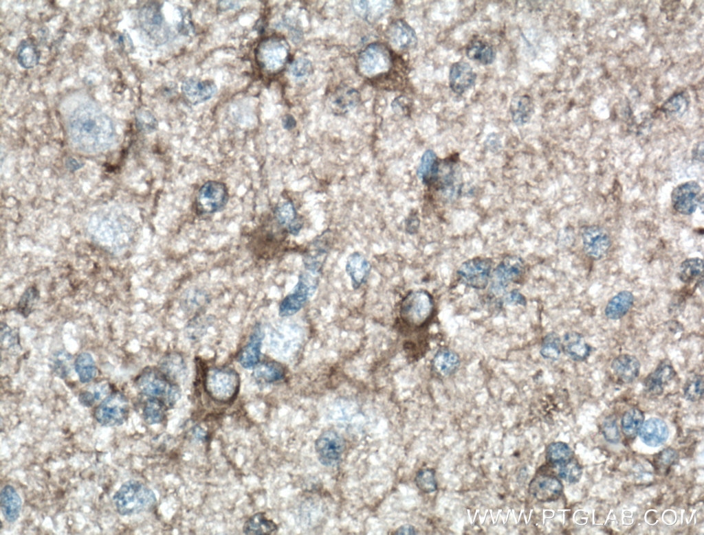 Immunohistochemistry (IHC) staining of human gliomas tissue using Septin 8 Polyclonal antibody (11769-1-AP)