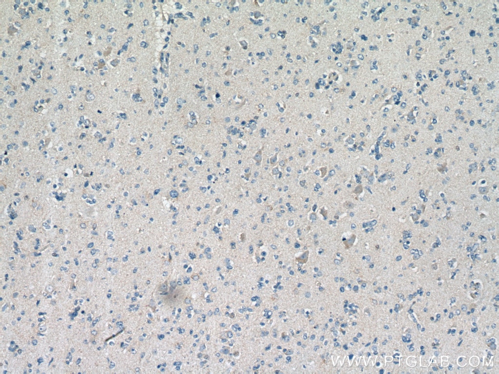 Immunohistochemistry (IHC) staining of human gliomas tissue using Septin 8 Monoclonal antibody (66188-1-Ig)