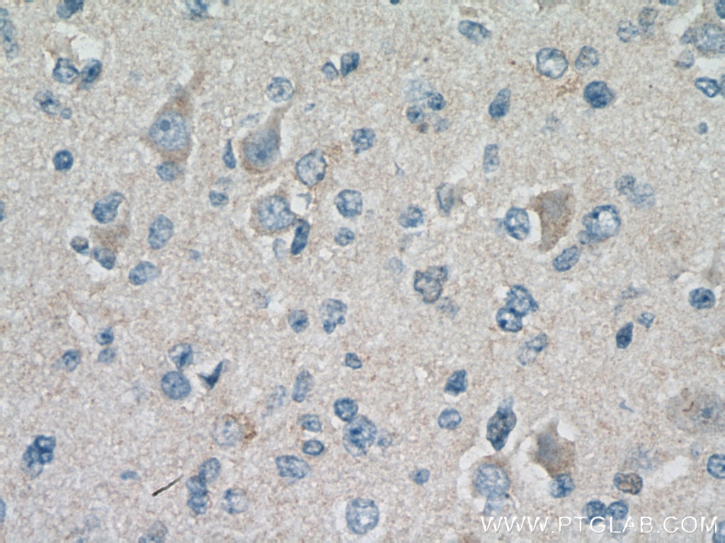 Immunohistochemistry (IHC) staining of human gliomas tissue using Septin 8 Monoclonal antibody (66188-1-Ig)