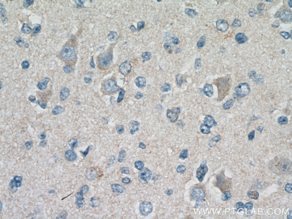 IHC staining of human gliomas using 66188-1-Ig