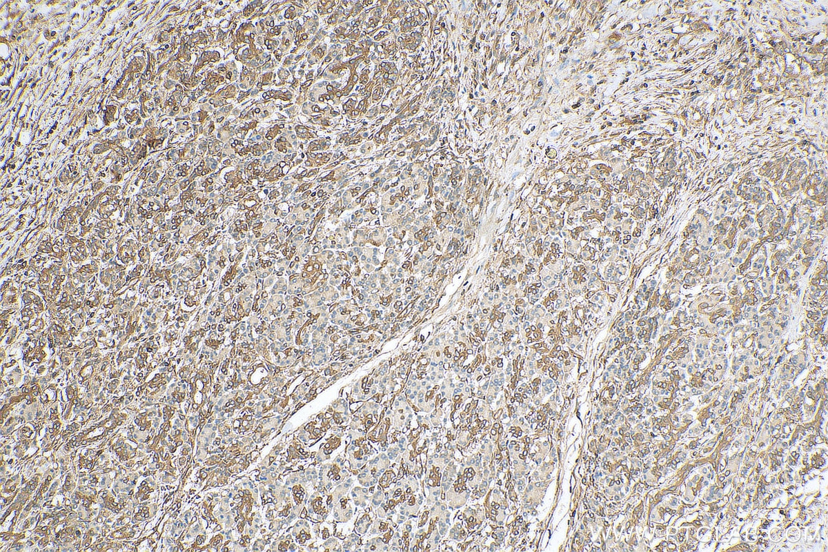 Immunohistochemistry (IHC) staining of human pancreas cancer tissue using Septin 9 Polyclonal antibody (10769-1-AP)