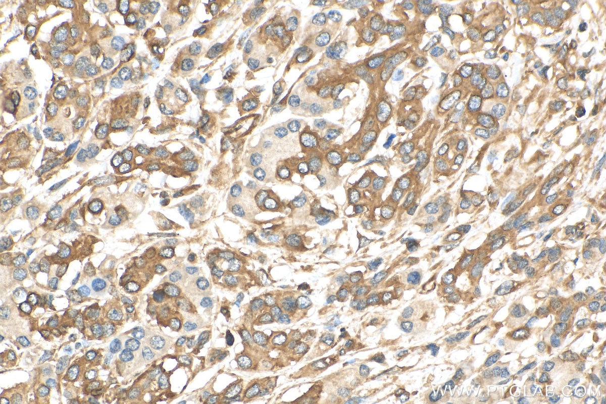 Immunohistochemistry (IHC) staining of human pancreas cancer tissue using Septin 9 Polyclonal antibody (10769-1-AP)