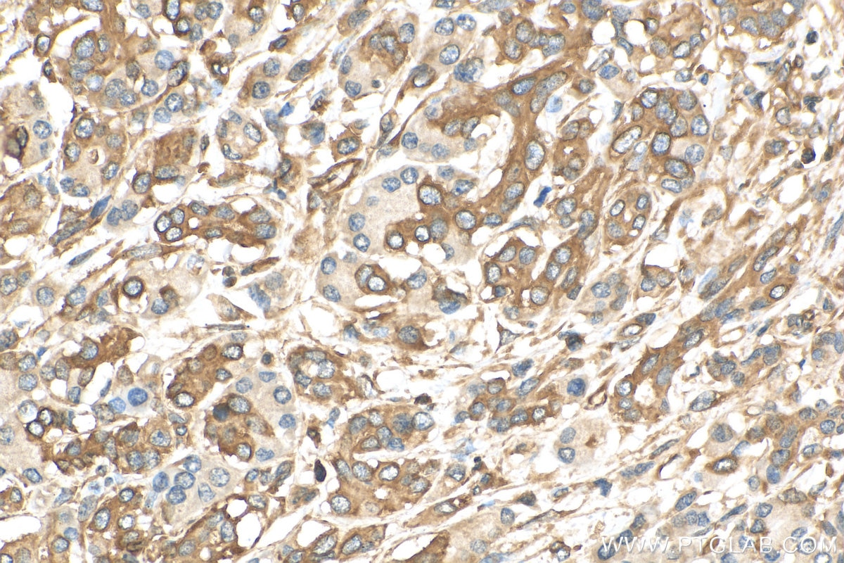 IHC staining of human pancreas cancer using 10769-1-AP