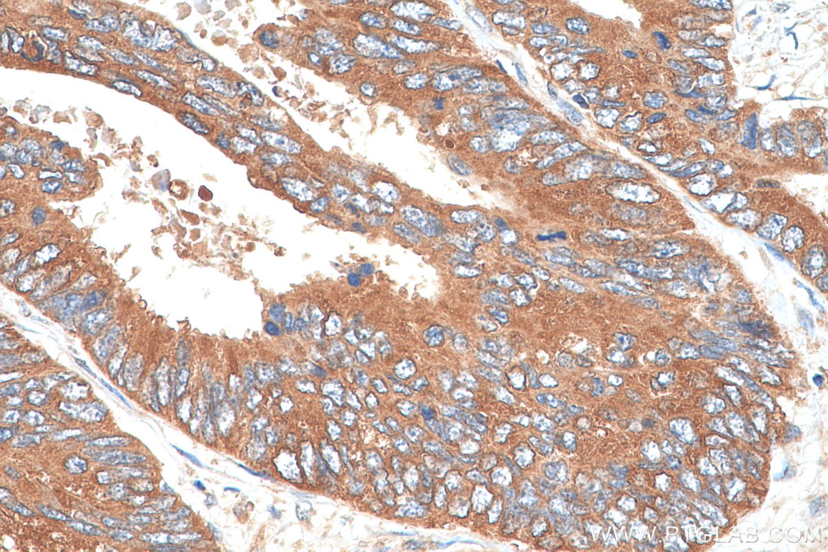 Immunohistochemistry (IHC) staining of human colon cancer tissue using SERBP1 Polyclonal antibody (10729-1-AP)