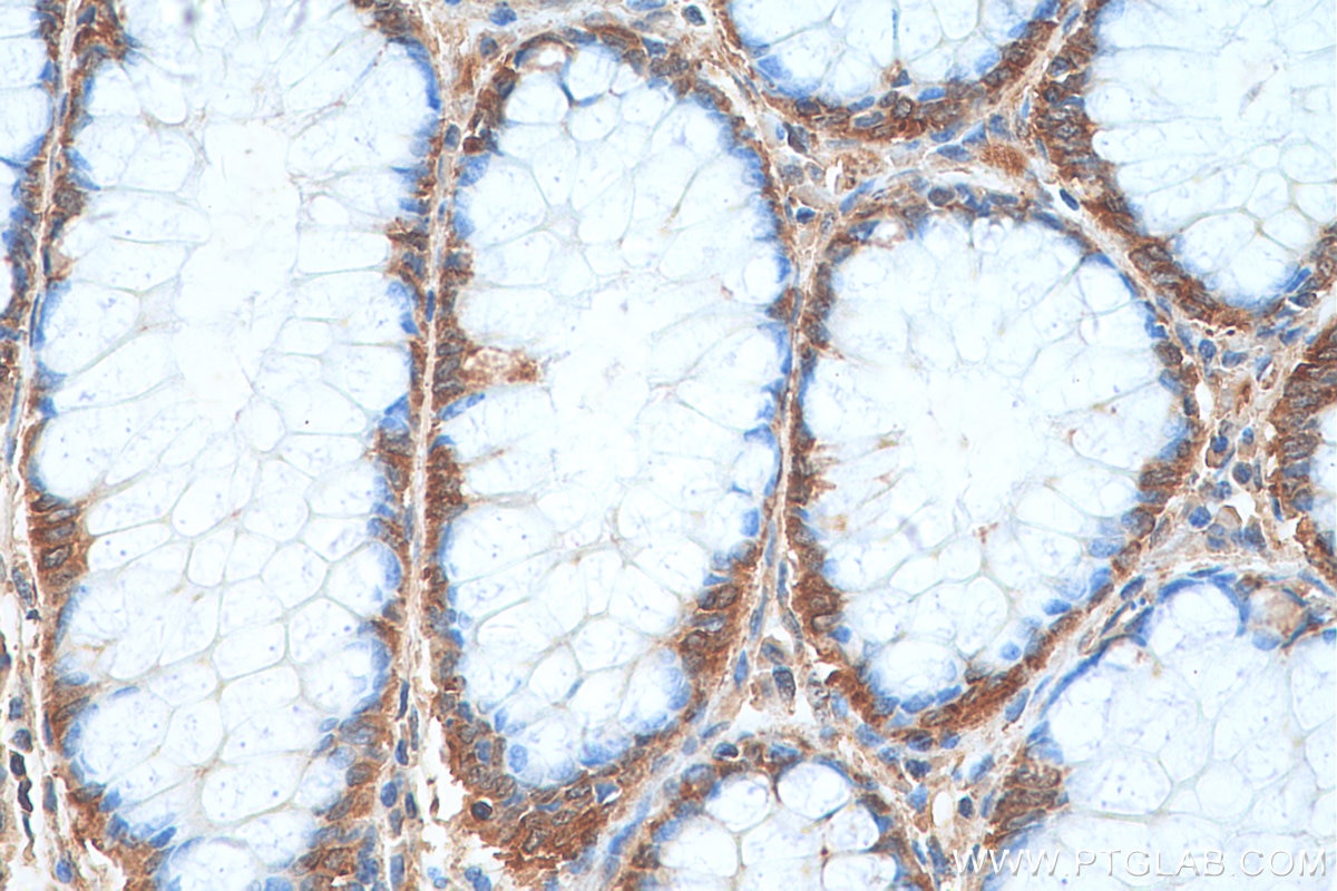 Immunohistochemistry (IHC) staining of human colon cancer tissue using SERBP1 Polyclonal antibody (10729-1-AP)