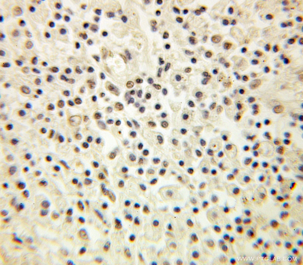 Immunohistochemistry (IHC) staining of human lung cancer tissue using SERBP1 Polyclonal antibody (10729-1-AP)