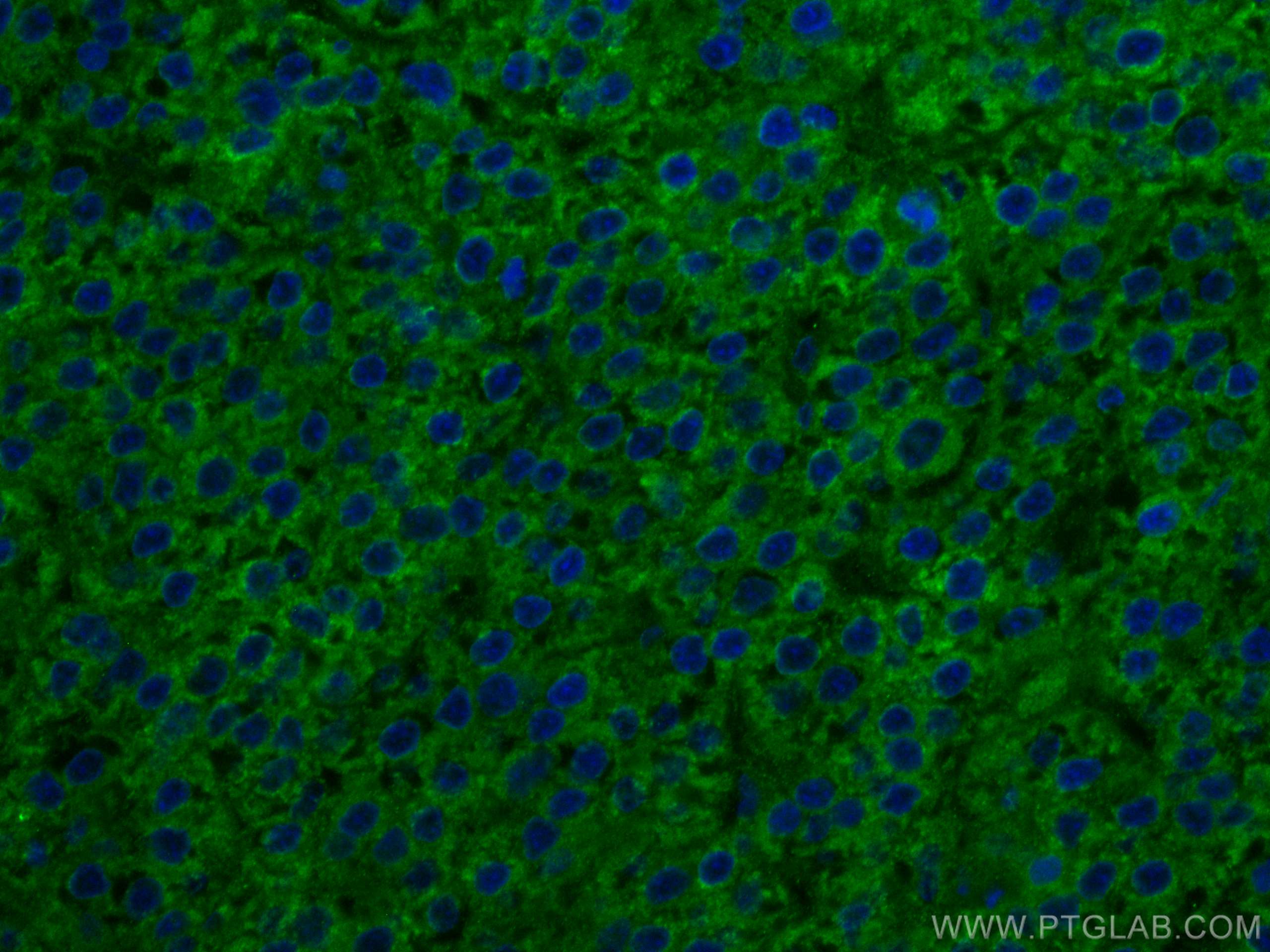 Immunofluorescence (IF) / fluorescent staining of human liver cancer tissue using SERBP1 Monoclonal antibody (67792-1-Ig)