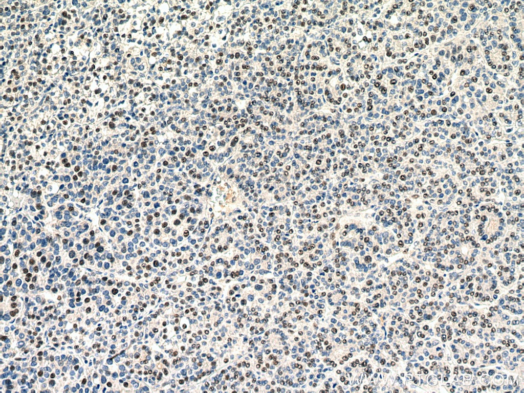 IHC staining of human liver cancer using 67792-1-Ig