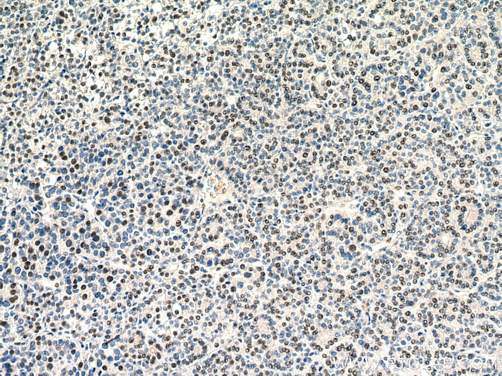 Immunohistochemistry (IHC) staining of human liver cancer tissue using SERBP1 Monoclonal antibody (67792-1-Ig)