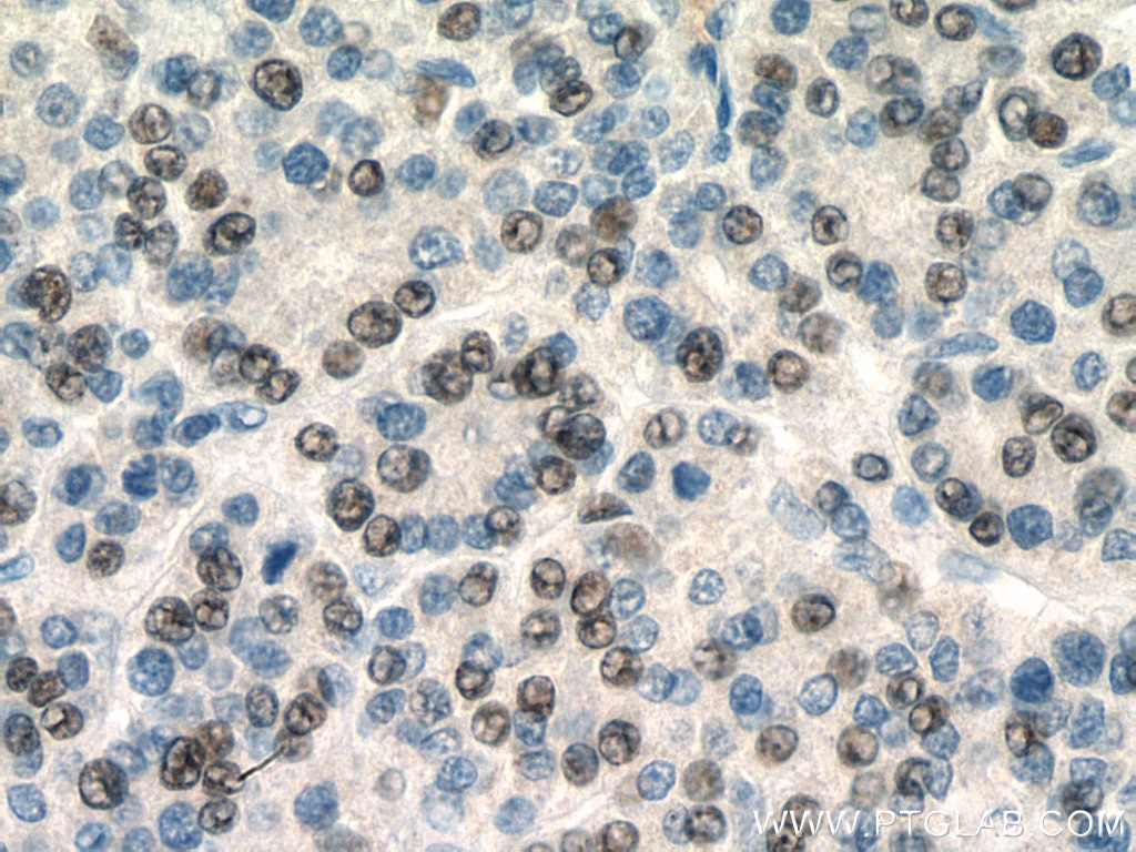 Immunohistochemistry (IHC) staining of human liver cancer tissue using SERBP1 Monoclonal antibody (67792-1-Ig)