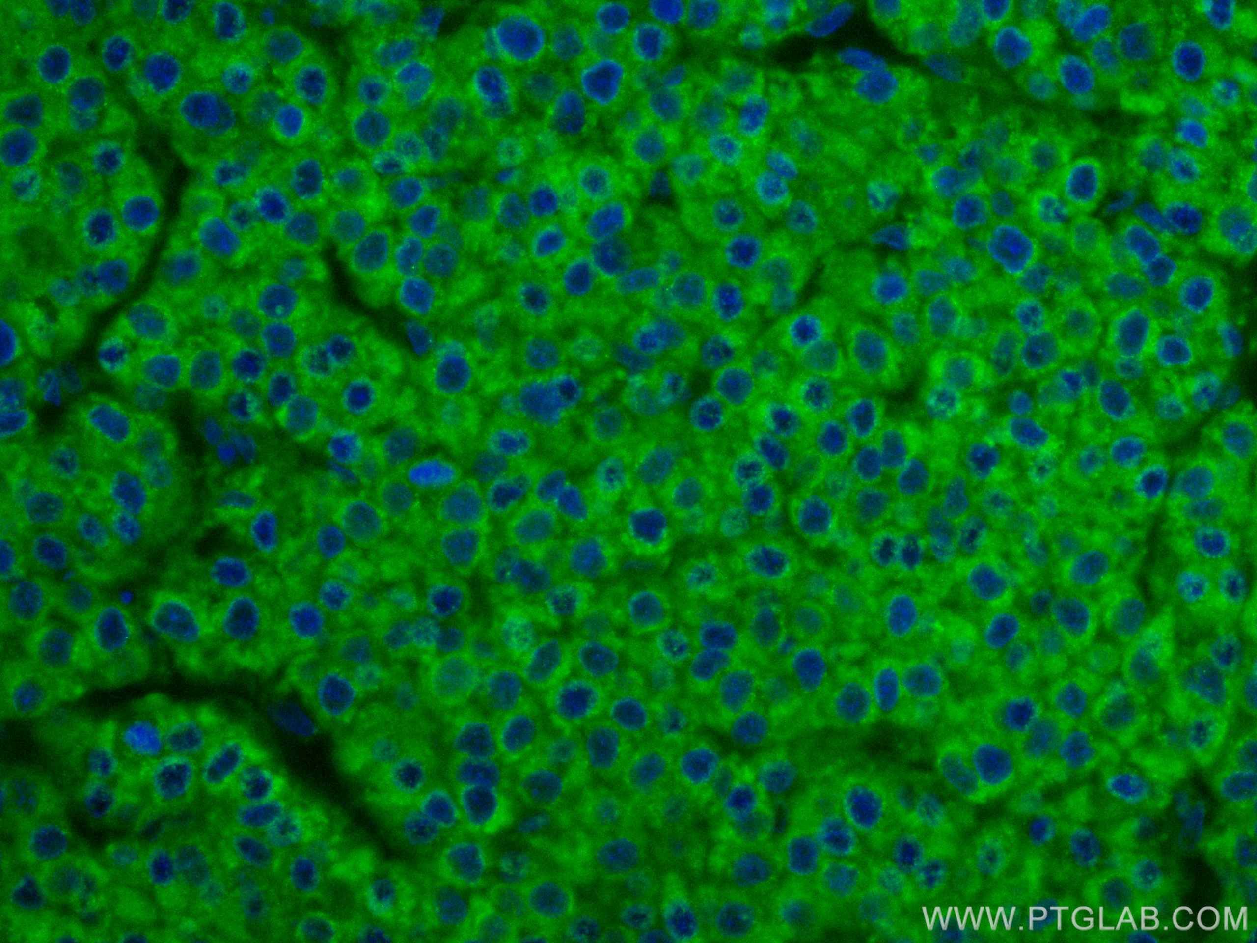 Immunofluorescence (IF) / fluorescent staining of human liver cancer tissue using CoraLite® Plus 488-conjugated SERBP1 Monoclonal an (CL488-67792)