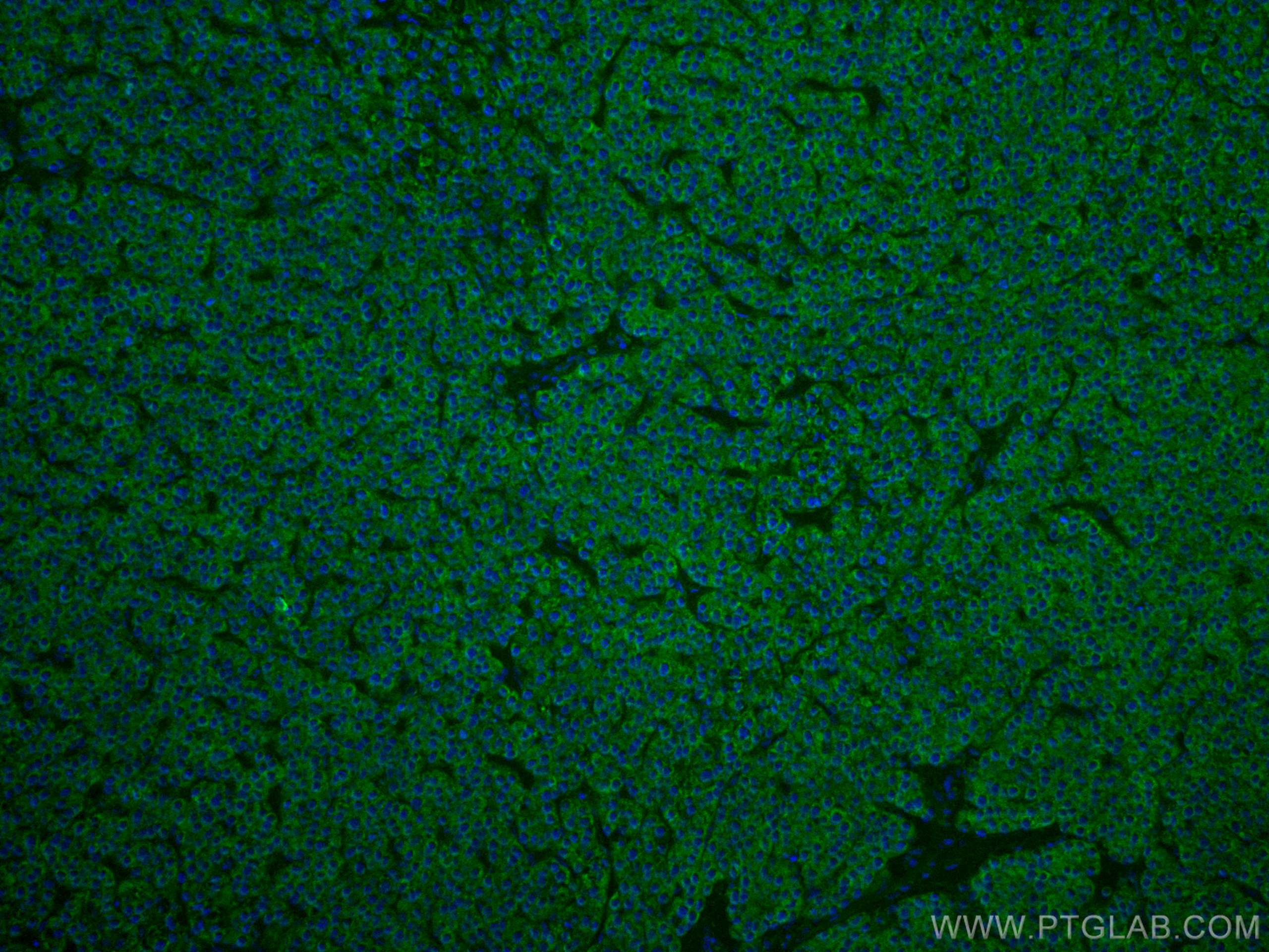 Immunofluorescence (IF) / fluorescent staining of human liver cancer tissue using CoraLite® Plus 488-conjugated SERBP1 Monoclonal an (CL488-67792)