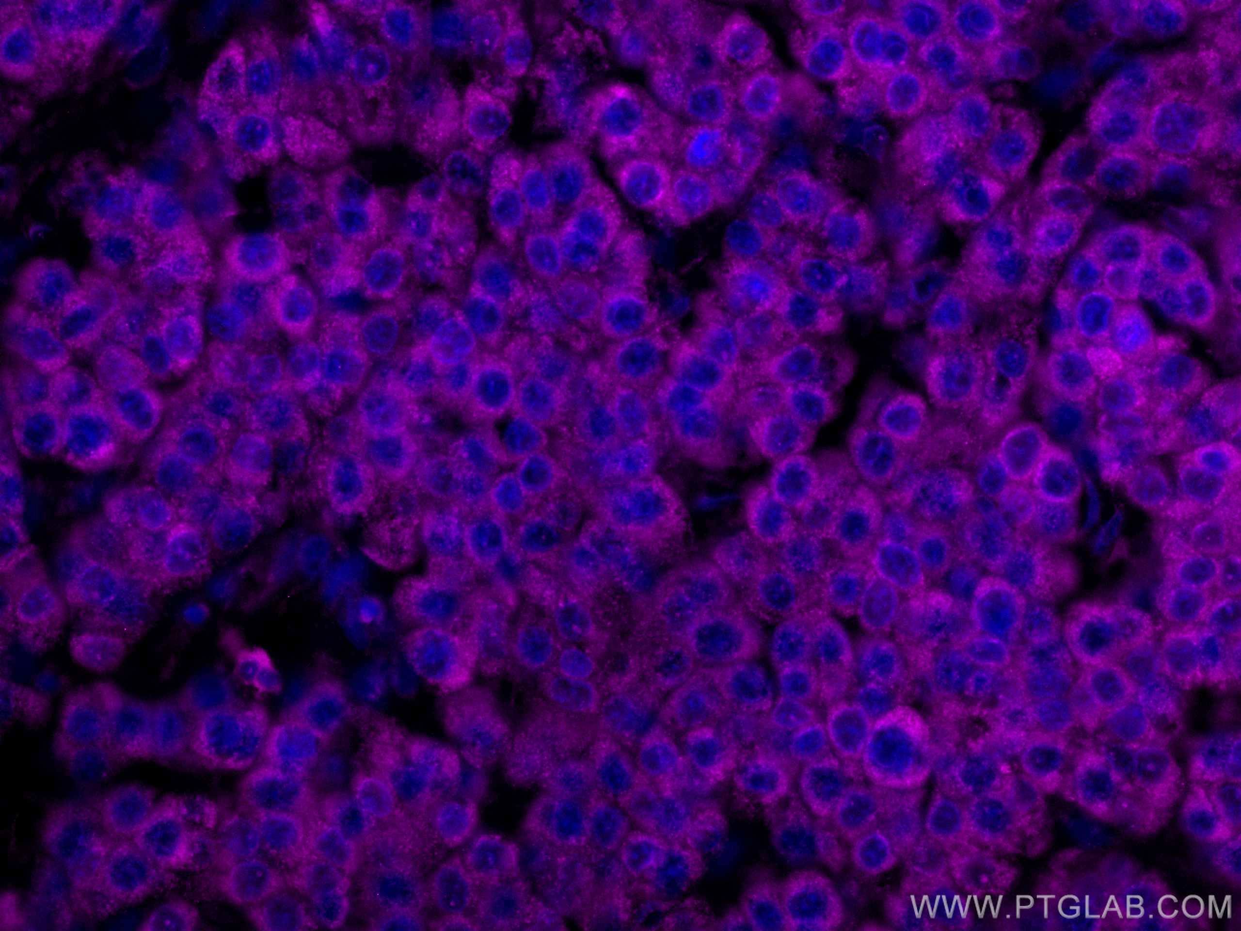 Immunofluorescence (IF) / fluorescent staining of human liver cancer tissue using CoraLite® Plus 647-conjugated SERBP1 Monoclonal an (CL647-67792)