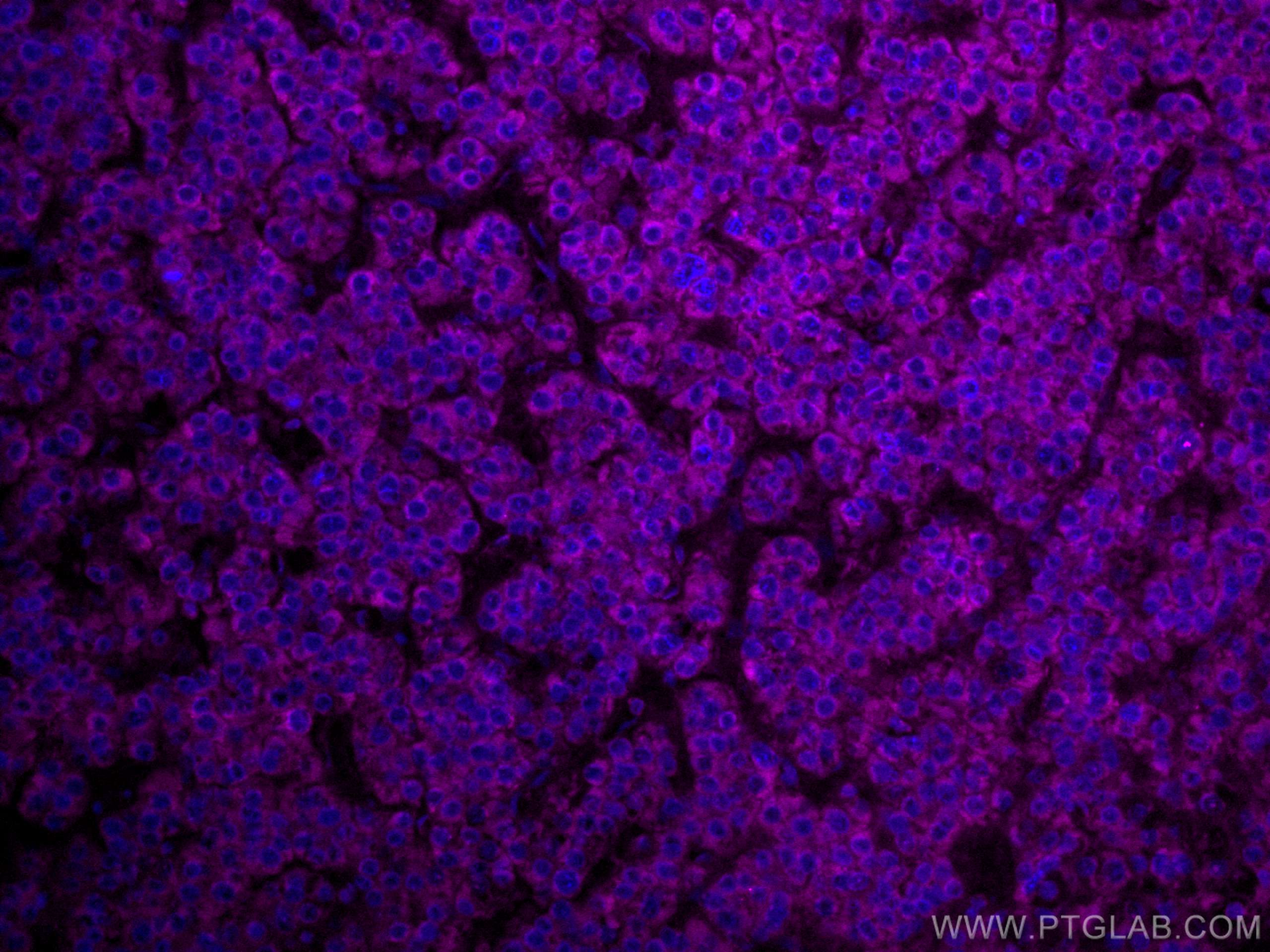 Immunofluorescence (IF) / fluorescent staining of human liver cancer tissue using CoraLite® Plus 647-conjugated SERBP1 Monoclonal an (CL647-67792)