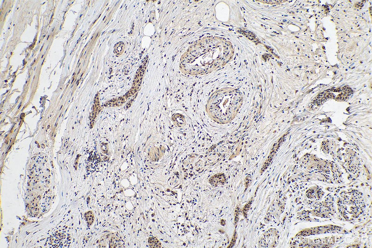 Immunohistochemistry (IHC) staining of human urothelial carcinoma tissue using SERCA2,ATP2A2 Monoclonal antibody (67248-1-Ig)