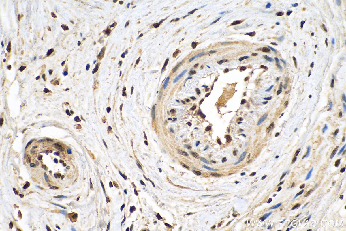 Immunohistochemistry (IHC) staining of human urothelial carcinoma tissue using SERCA2,ATP2A2 Monoclonal antibody (67248-1-Ig)