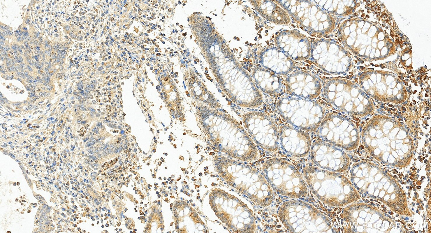 Immunohistochemistry (IHC) staining of human colon cancer tissue using SERCA3 Monoclonal antibody (68287-1-Ig)