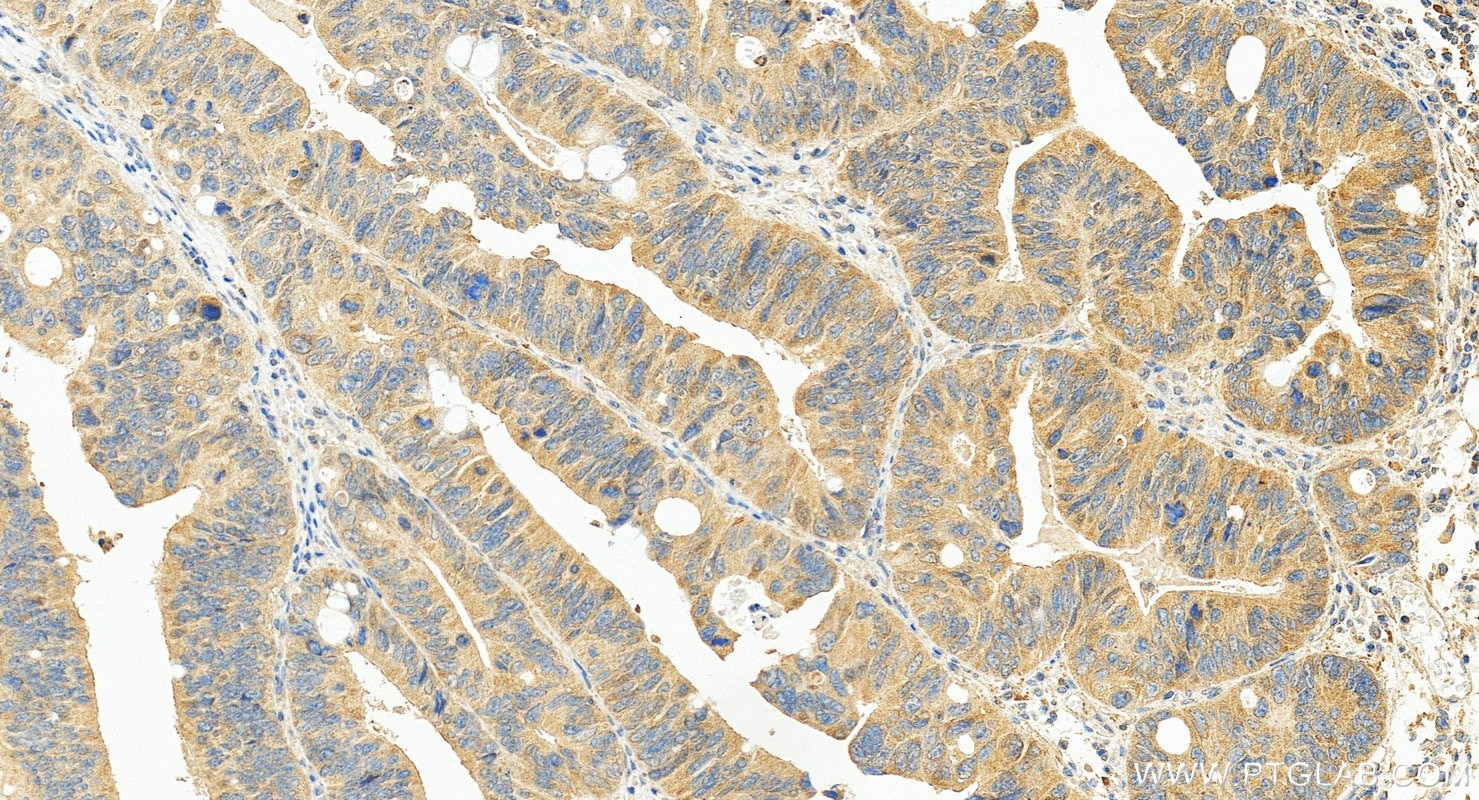 Immunohistochemistry (IHC) staining of human colon cancer tissue using SERCA3 Monoclonal antibody (68287-1-Ig)