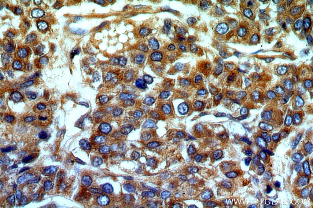 Immunohistochemistry (IHC) staining of human liver cancer tissue using SERINC1 Polyclonal antibody (20265-1-AP)