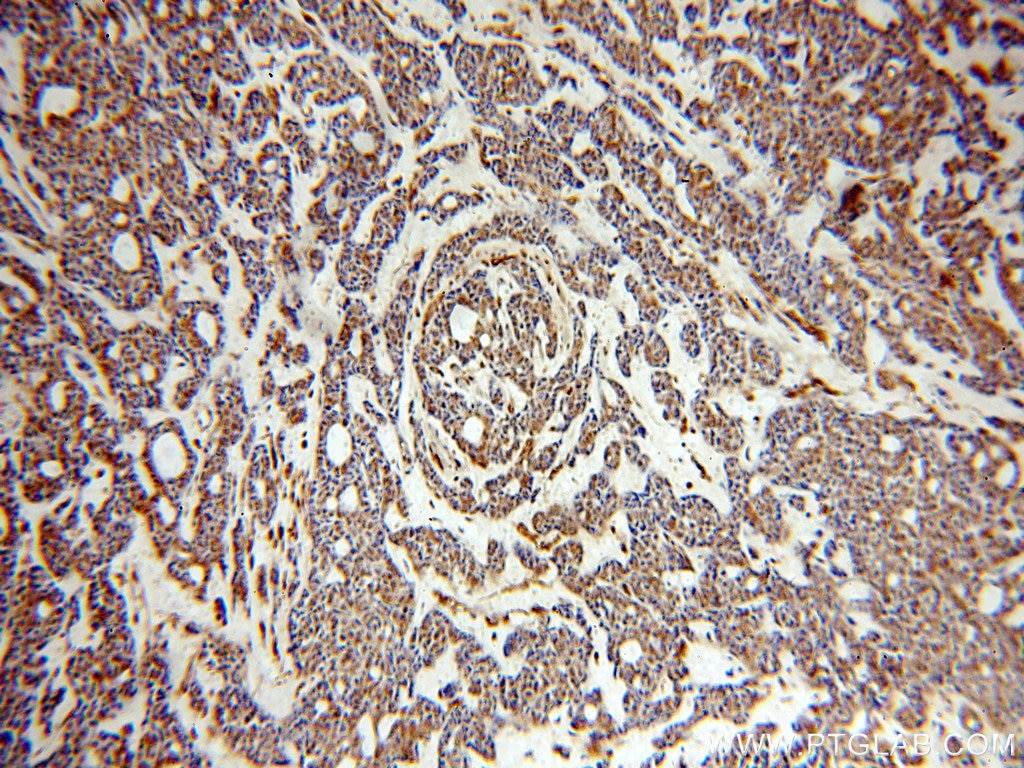 Immunohistochemistry (IHC) staining of human cervical cancer tissue using SERINC1 Polyclonal antibody (20265-1-AP)
