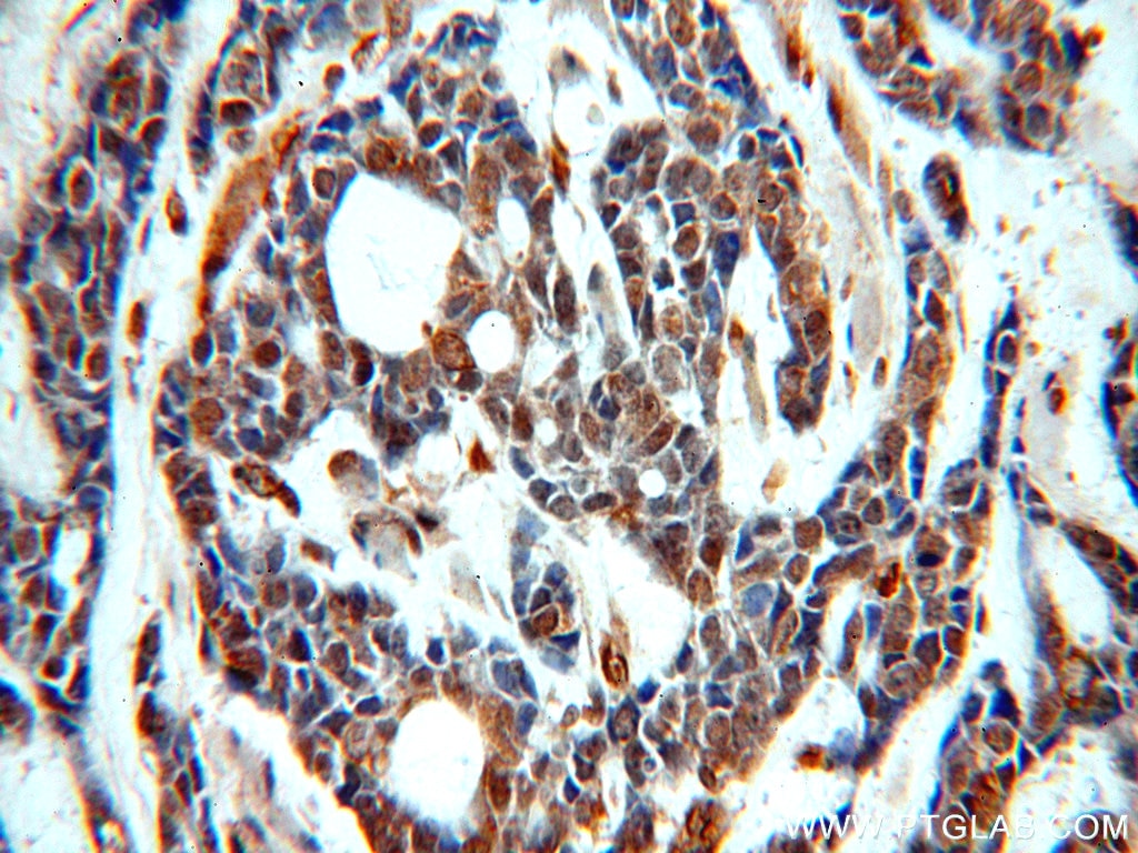 Immunohistochemistry (IHC) staining of human cervical cancer tissue using SERINC1 Polyclonal antibody (20265-1-AP)