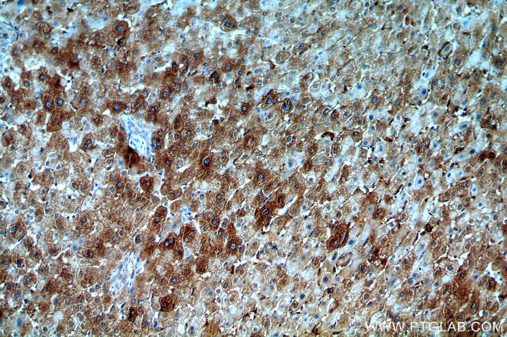 Immunohistochemistry (IHC) staining of human liver cancer tissue using SERINC1 Polyclonal antibody (20265-1-AP)