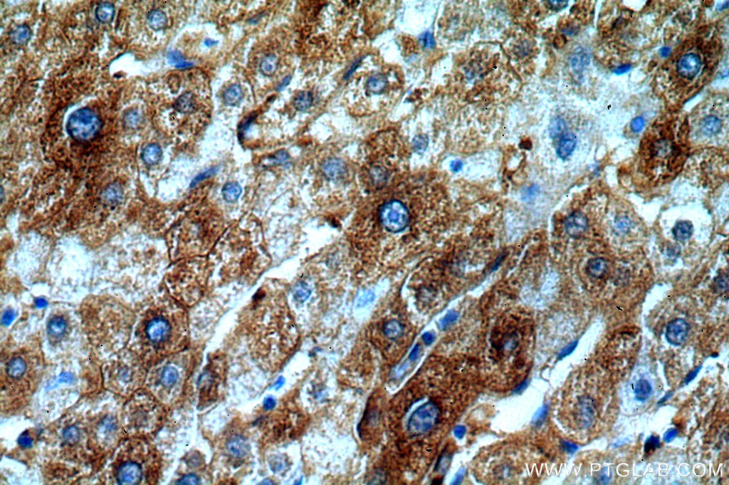 Immunohistochemistry (IHC) staining of human liver cancer tissue using SERINC1 Polyclonal antibody (20265-1-AP)
