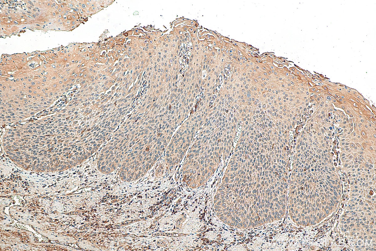 Immunohistochemistry (IHC) staining of human oesophagus cancer tissue using SERINC5 Polyclonal antibody (27066-1-AP)