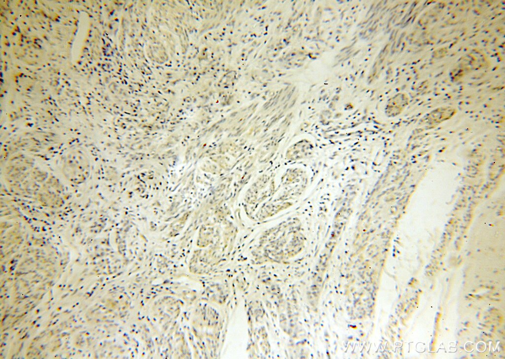 IHC staining of human endometrial cancer using 17807-1-AP