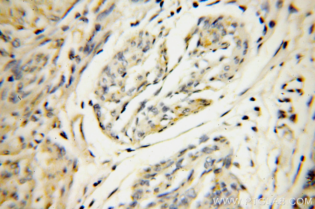 Immunohistochemistry (IHC) staining of human endometrial cancer tissue using SERP1 Polyclonal antibody (17807-1-AP)