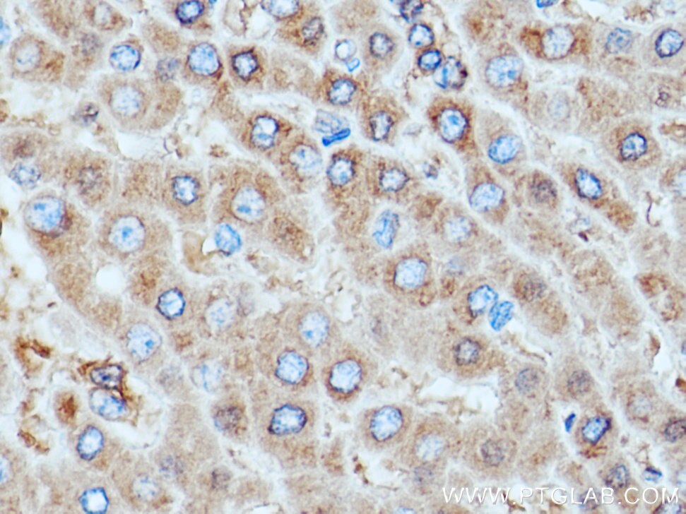 Immunohistochemistry (IHC) staining of human liver cancer tissue using Alpha 1 Antitrypsin Polyclonal antibody (16382-1-AP)
